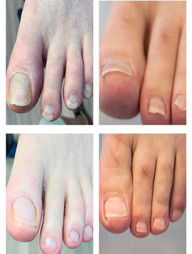 Behandling af meget hårdhud og svære tånegle - kompliceret fodbehandling